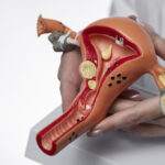 a doctor show dummy model to her patient before endometriosis surgery