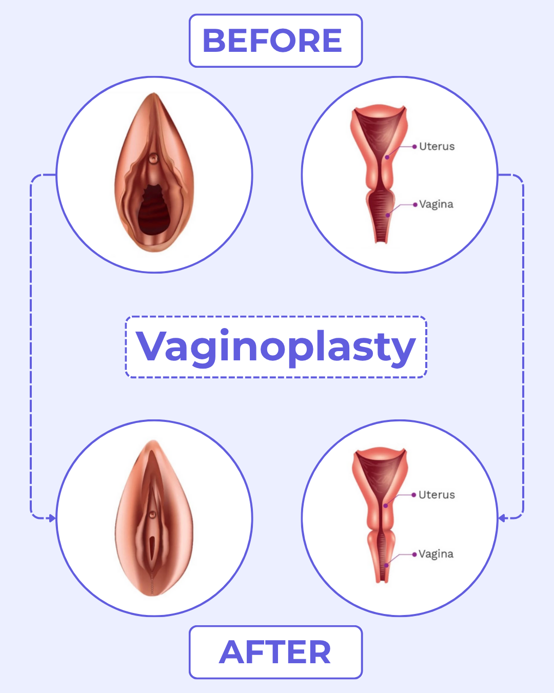Vaginoplasty surgery before and after results showing vaginal tightening.