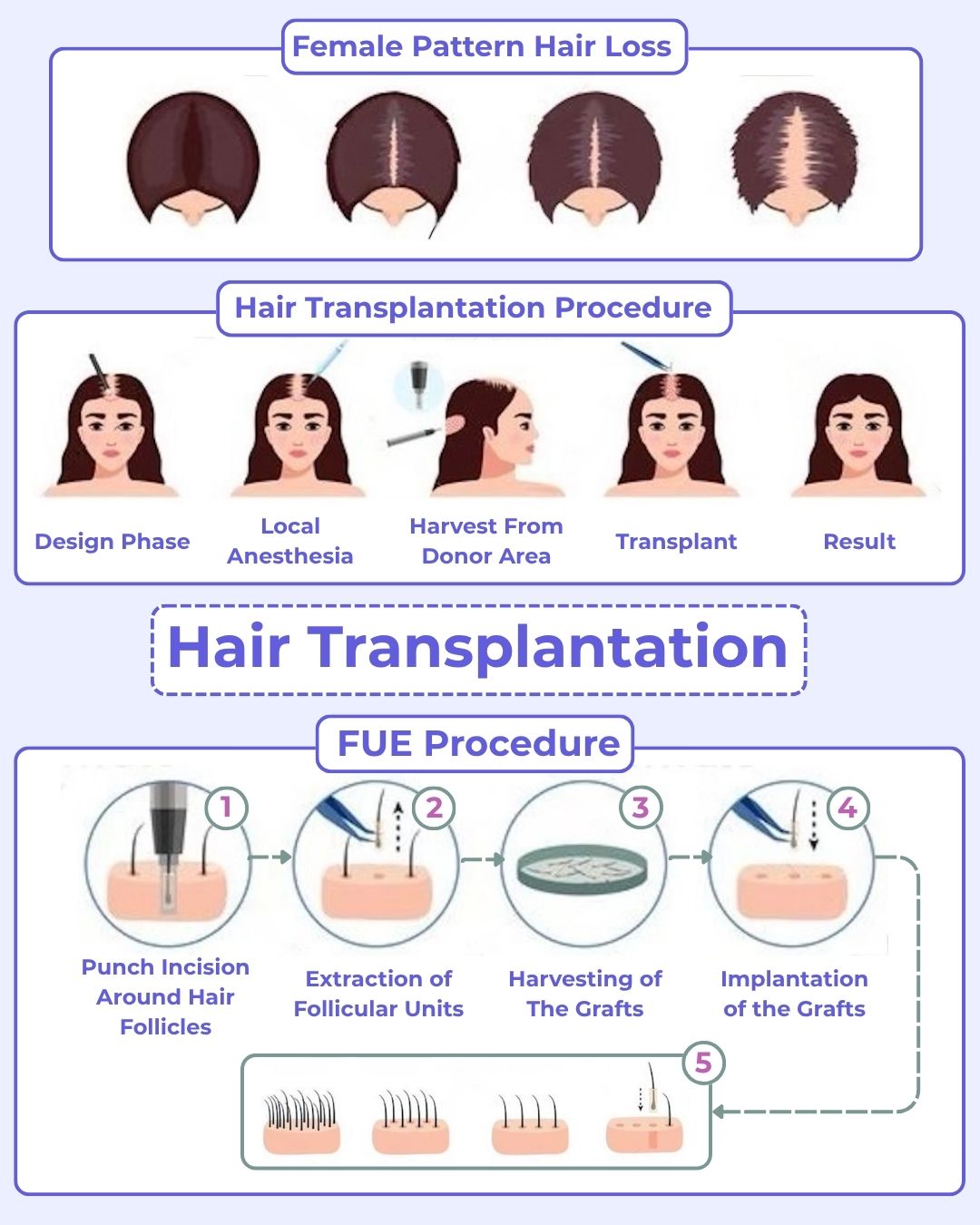 The illustration shows hair transplantation procedure for women