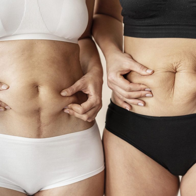 two women shows their body before body liposuction