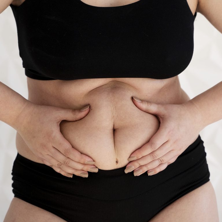woman patient shows her belly before mommy makeover