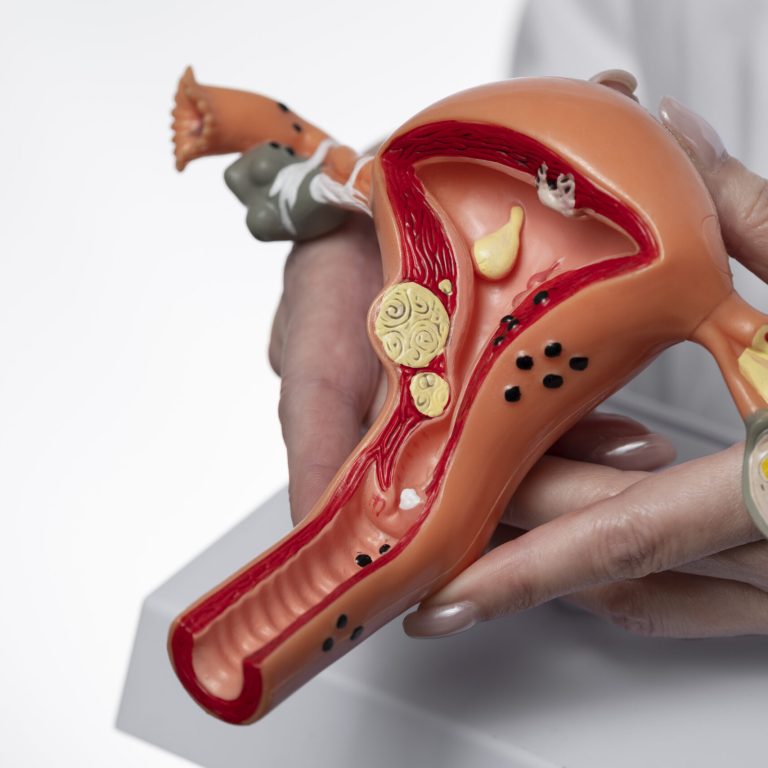 a doctor show dummy model to her patient before endometriosis surgery