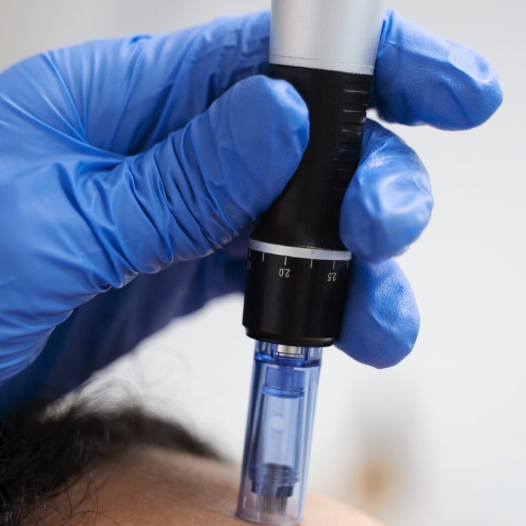 an expert performs microneedling to her patient