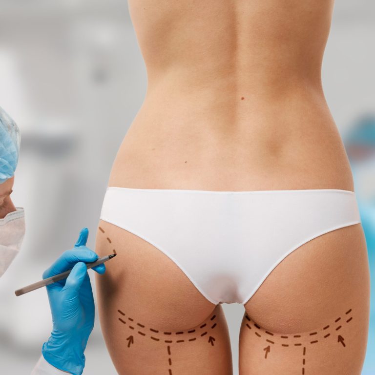 doctor draw target area on her patient in the photo before brazilian butt lift